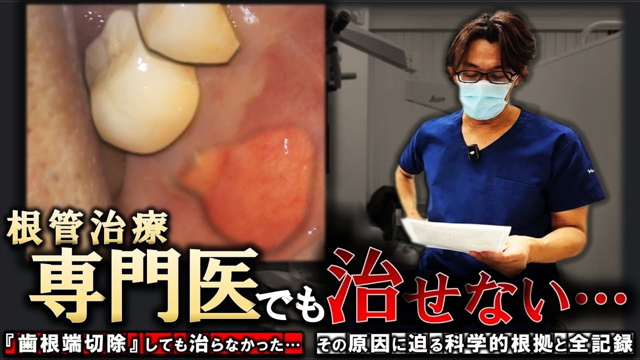 なぜ、根管治療専門医でも治せなかったのか？その「真実」に迫る科学的