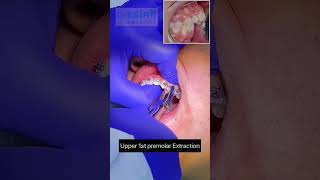 OMG Watch Tooth extraction in seconds  خلع الضرس في ثواني قليلة ل تقويم ضب الأسنان reels dentist