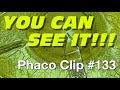 Phaco Clip #133 - Whitish Pre-Intumescent