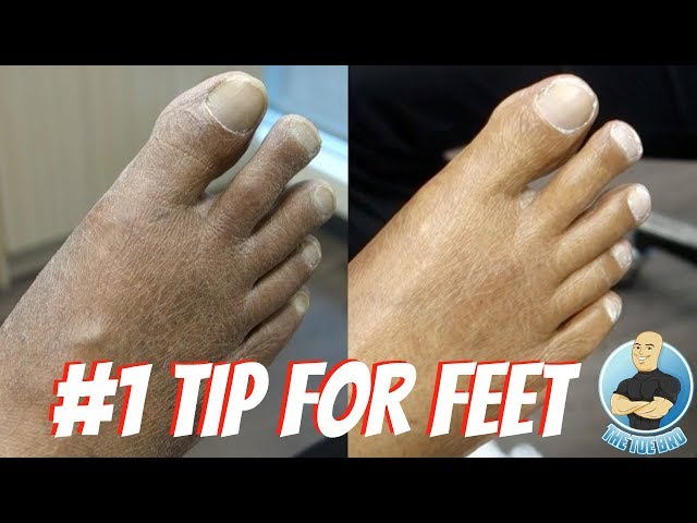 Callus Removal At Home: 5 Top Tips - Northwich Foot Clinic