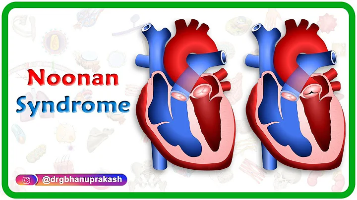 Noonan syndrome - Usmle step 1