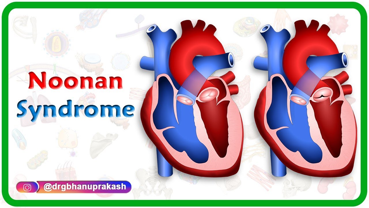 Noonan Syndrome Heart Defects