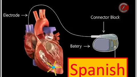 ¿Qué es mejor que un marcapasos?