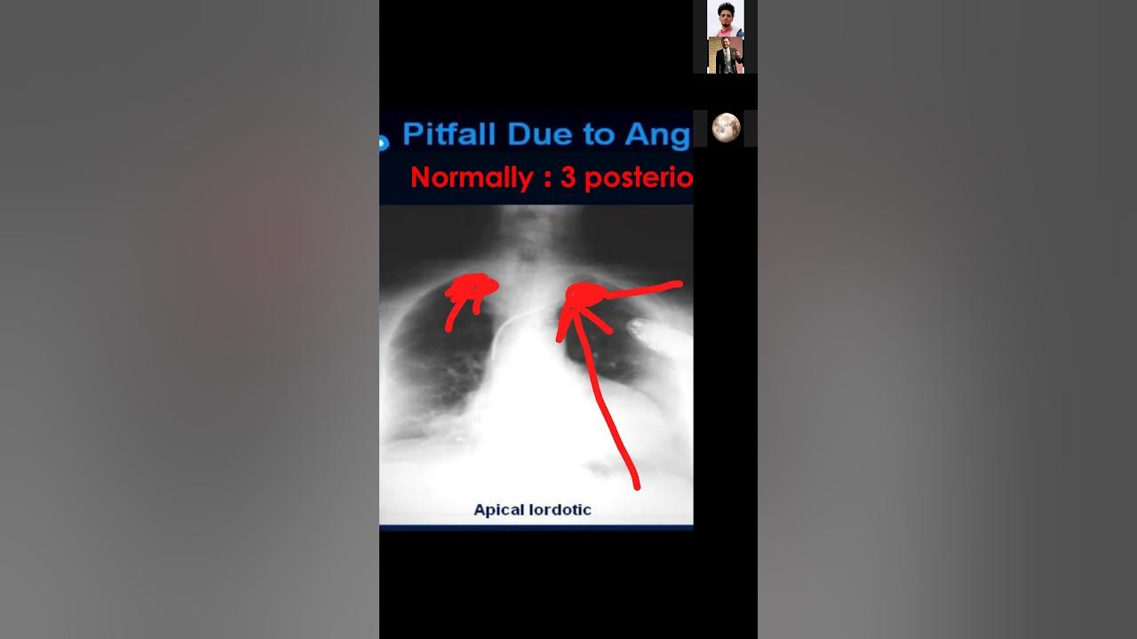 chest Xray course (Part 4) YouTube