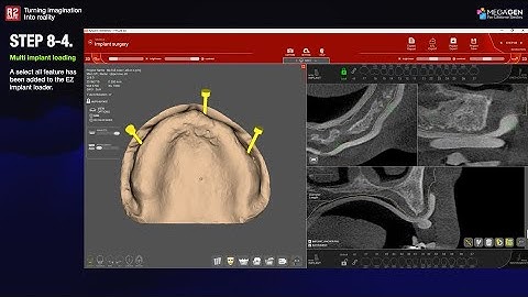 [EN] R2GATE Stand Alone update: Step. 8-4 A "Select All" option is added to the EZ Implant loader.