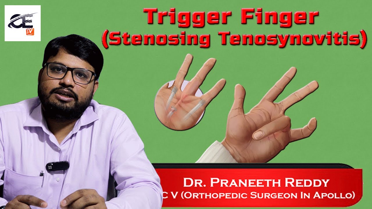 Trigger Finger Stenosing Tenosynovitis How To Heal Trigger Finger trigger-finger-stenosing-tenosynovitis-how-to-heal-trigger-finger