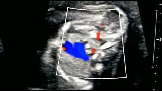 Aberrant right subclavian artery - MINDRAY - NUEWA i9 screenshot 3