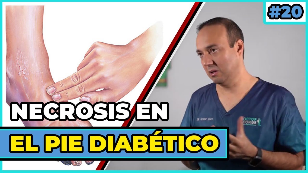 Necrosis en pie diabético YouTube