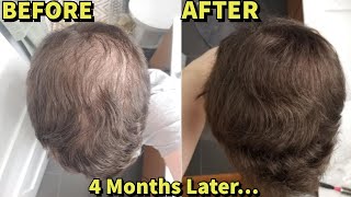 He Was Microneedling WITHOUT For 4 Months SHOCKING Results