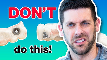 Perfect the Prototype for Perfect Full Arch