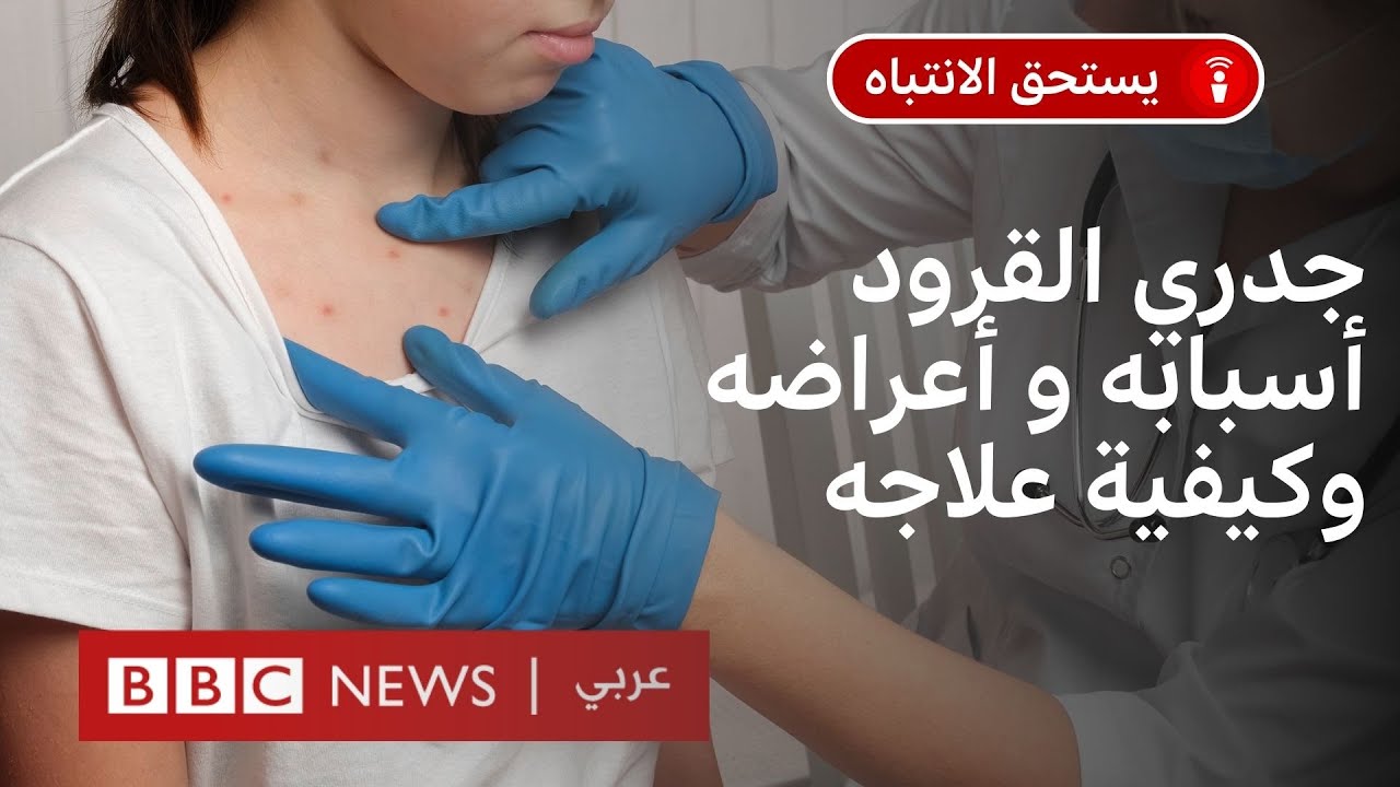 جدري القرود .. ماذا نعرف عنه وما درجة خطورته؟