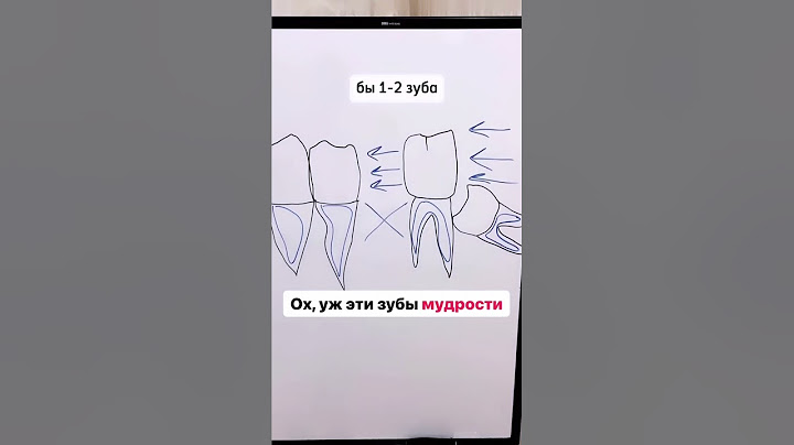 Болит зуб мудрости. Удалять зуб мудрости?