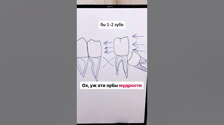 Болит зуб мудрости. Удалять зуб мудрости?