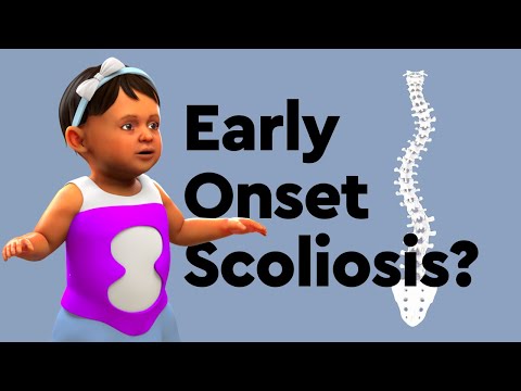 Video: Scoliosis Grade 3 - Features, Symptoms And Treatment