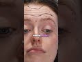 Forehead Botox tutorial