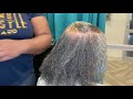 She has alopecia in the top of her head  | Thinning in the top of her head| Androgenic Alopecia