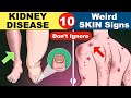Skin signs of kidney disease  chronic kidney disease  kidney failure symptoms  ckd