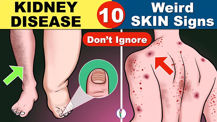 Skin signs of Kidney Disease | Chronic Kidney Disease | Kidney Failure Symptoms | CKD - DayDayNews