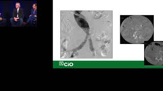 Embolic Selection and Techniques in the Management of Endoleaks, Pulmonary AVMs, and Aneurysms