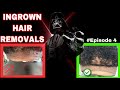 InGrown Hair Removals | 4 Part Series | # Episode 4