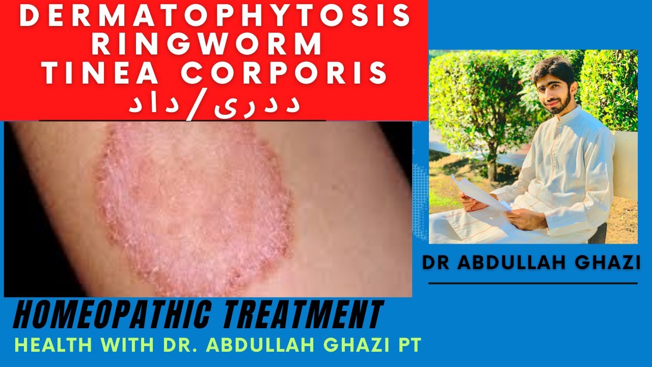 Dermatophytosis / Ringworm / Tinea Corporis داد / ددری = Homeopathic ...