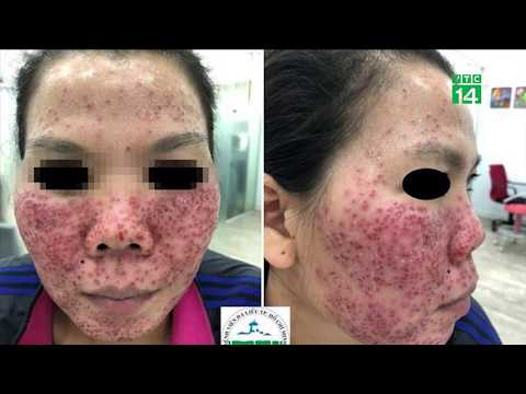 Video Bong tróc mặt do lột da bằng vi tảo biển| VTC14 - youtube