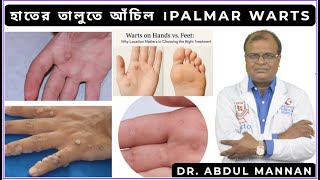 Warts on the palm of the hand. Palmar Warts. Homeopathic treatment. DR. MD. ABDUL MANNAN