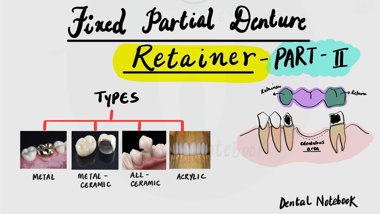 Fixed Partial Denture [ Retainer] part -2  [ classification ... continued.. ]