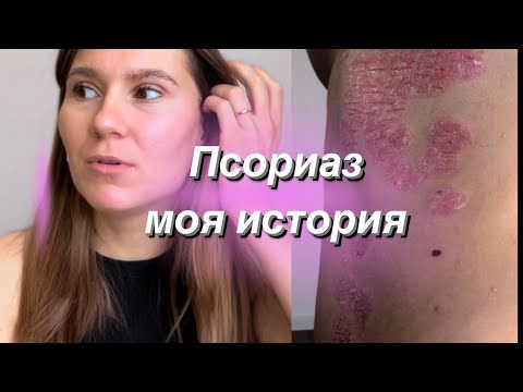 Псориаз как лечить, что кушать моя история