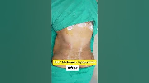 360° Abdomen Liposuction result #shorts