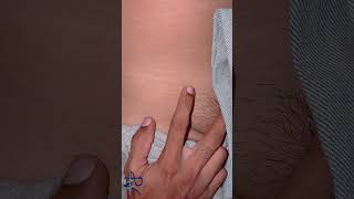 How to Detect Direct and Indirect Inguinal Hernia…..