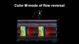 Echocardiography Essentials: Detecting aortic regurgitation screenshot 5