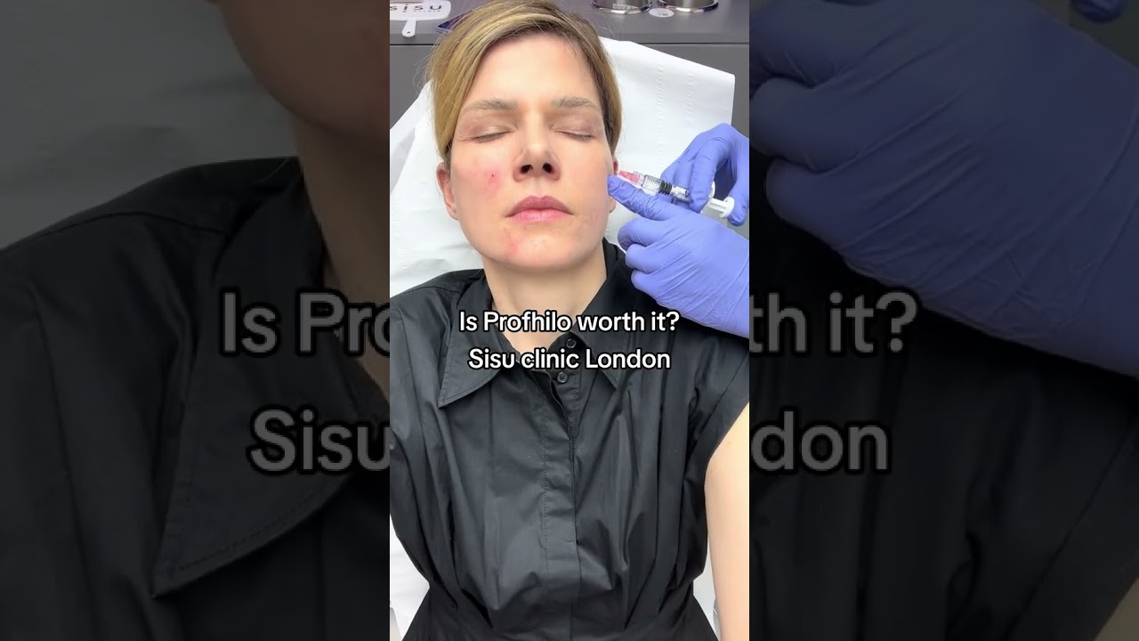 Is Profhilo really worth the hype? 💉✨ 