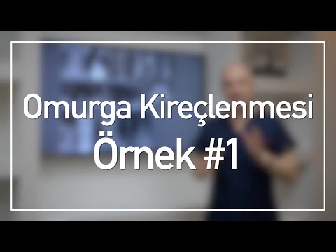 TLIF | Omurga Kireçlenmesi Vaka Örnekleri #1