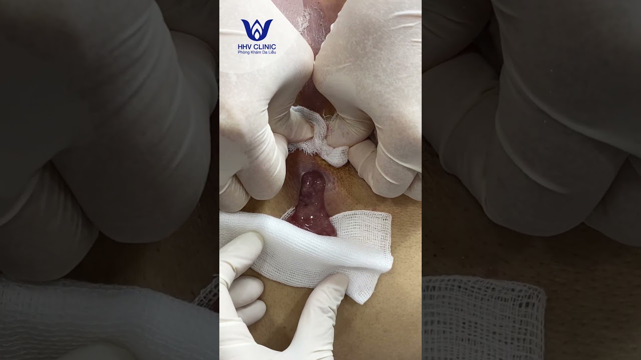 Nặn mụn áp xe chứa nhiều dịch mủ.