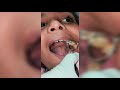 8 Sal Ke Bache Ka Cap |Metal Cap On Teeth |Cost Of Root Canal Treatment |Cost Of Teeth Cap