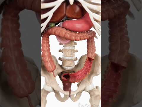 التهاب الرتج هو التهاب جيوب صغيرة بالقولون يسبب ألم ا واضطرابات هضمية التهاب الرتج القولون تحليل