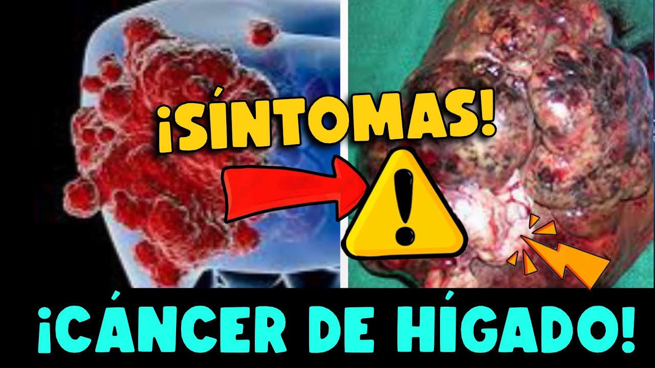 ¡CUIDADO! SI TIENE ESTOS SÍNTOMAS PUEDE TENER CÁNCER DE HÍGADO