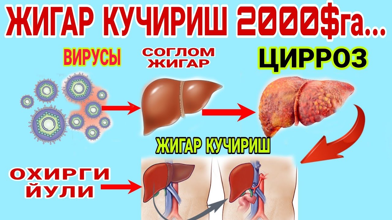 Jigar ko’chirib o’tqazish narxi qancha? 