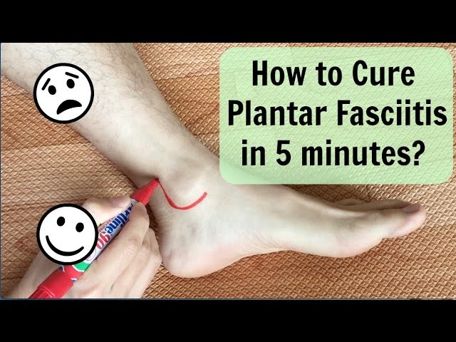 cupping therapy for plantar fasciitis