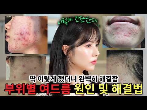 ⭐부위별 여드름 원인 및 해결법⭐ (진짜 어이가 없지만 이렇게 간단하게 없앨 수 있습니다)