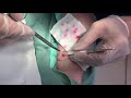 脂肪腫くりぬき法 30代女性腕epidermal cyst atheroma cystic acne extraction 粉瘤lipoma クリニーク大阪心斎橋・大阪梅田・名古屋栄・福岡天神・神戸院