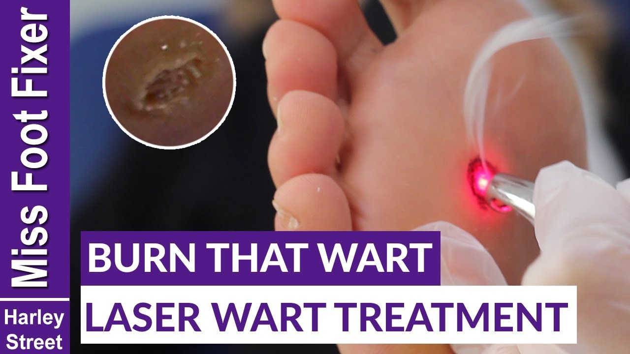 LASER TREATMENT FOR WARTS BY MISS FOOT FIXER