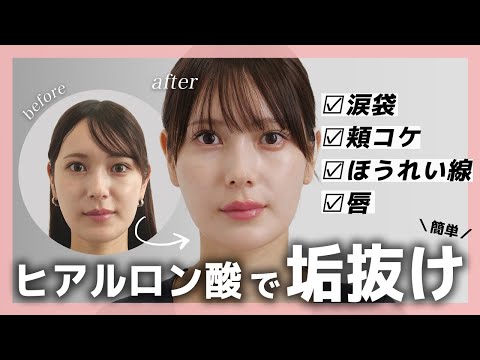 【コスパ×タイパ最強】気になる箇所全部ヒアルロン酸で解決！【涙袋・頬コケ・ほうれい線・唇】