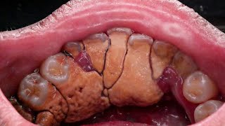 UNBELIEVABLY GIGANTIC TARTAR | KARANG GIGI | Dentist | Dokter Gigi Tri Putra