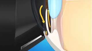 Glauc Anim Laser Trabeculoplasty