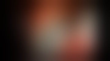 Complications of polypectomy 1: Bleeding