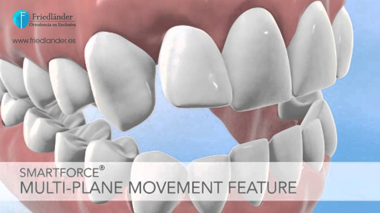 Invisalign G4 new  - Ortodoncia Friedländer Barcelona