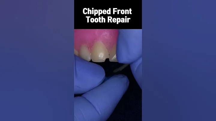 Chipped Front Tooth Repair - Composite Resin #shorts