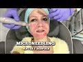 MICRONEEDLING   antes y despues   rejunvenecimiento